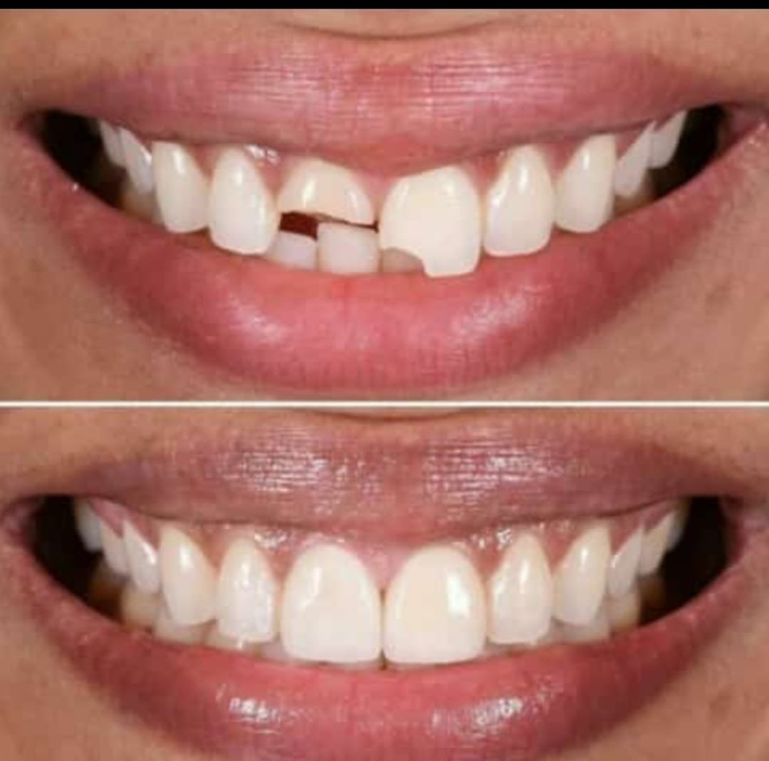 Spesialis Veneer Gigi Bekasi & Perawatan Estetika Gigi–Ratu Dental Bekasi Spesialis Veneer Gigi Bekasi